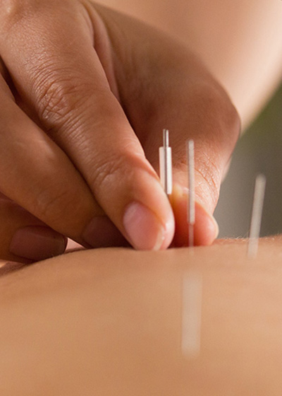 Akupunktur er behandling med nåle efter ældgamle kiniske forskrifter - prøv det hos Rødovre Fysioterapi & Sundhedshus, vi dækker hele København. 